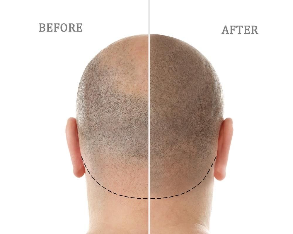Microscalp